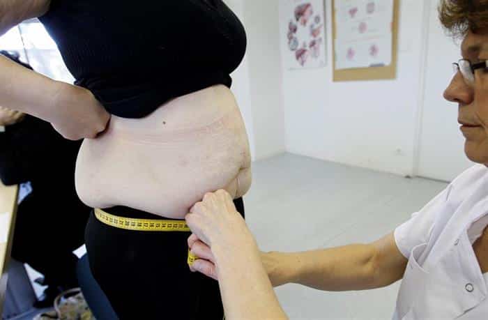 Governo acelera cirurgias contra a obesidade